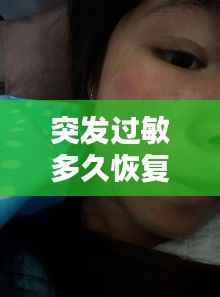突发过敏多久恢复,突发过敏怎么办